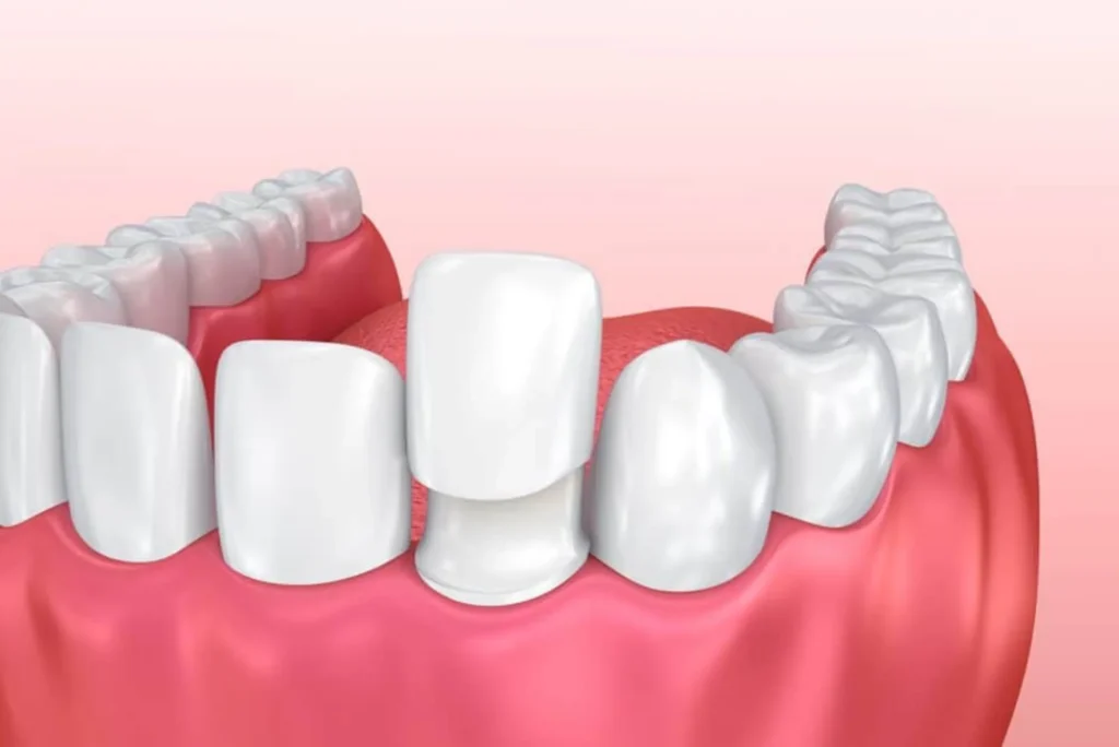 How Much do Veneers Cost in Dubai