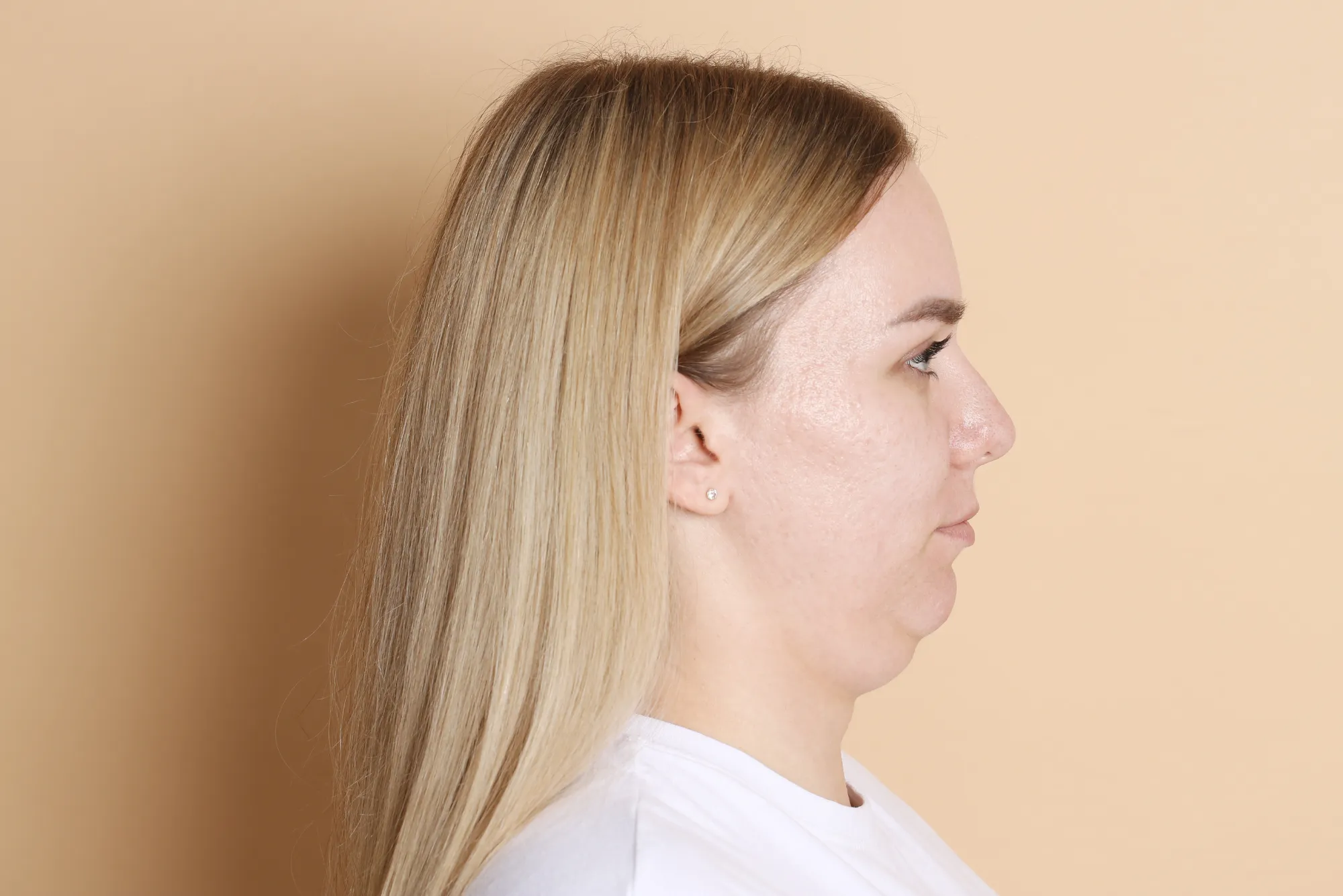 إزالة الذقن المزدوج في دبي لخط فك أوضح